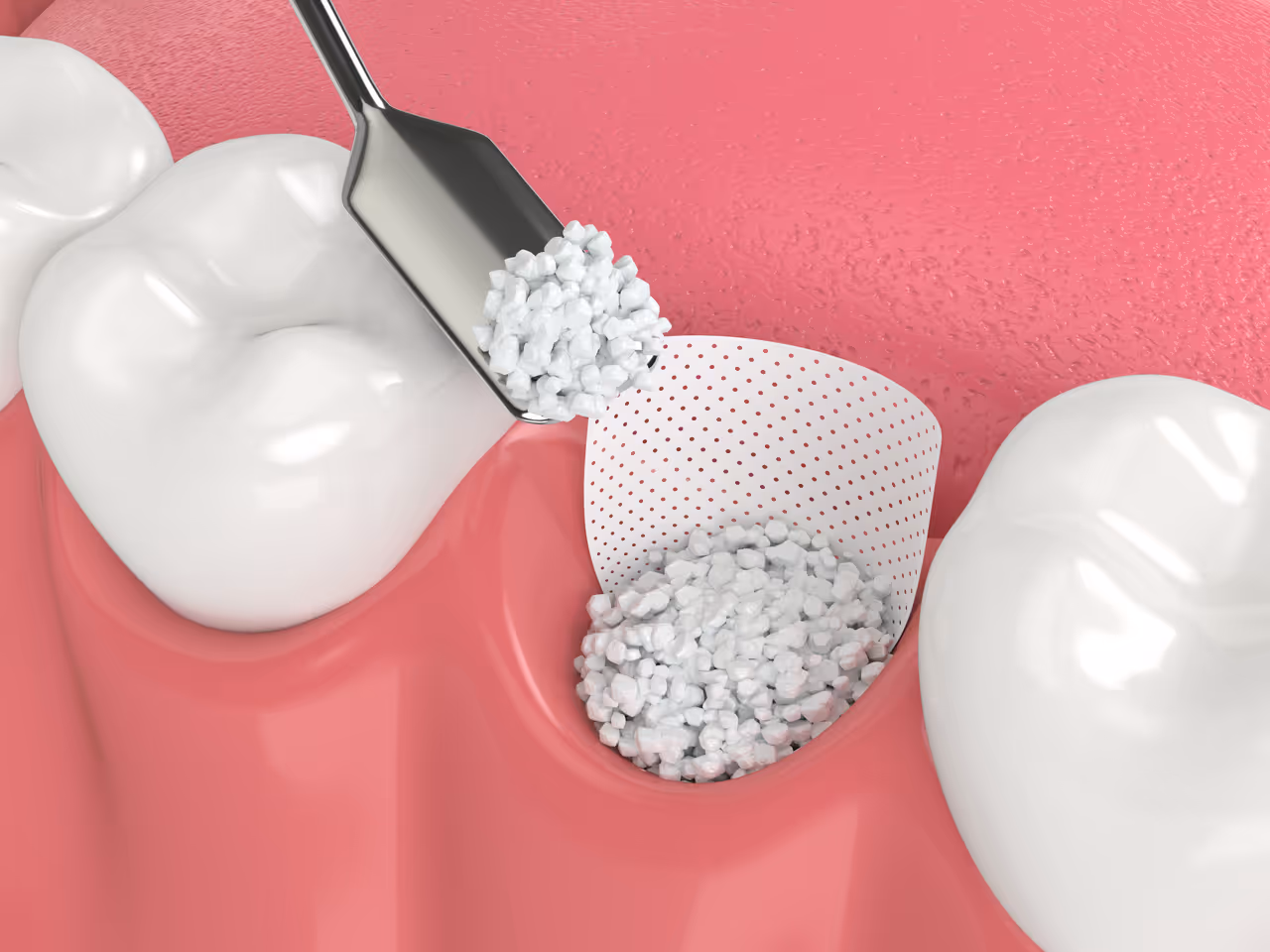 Bone Grafting