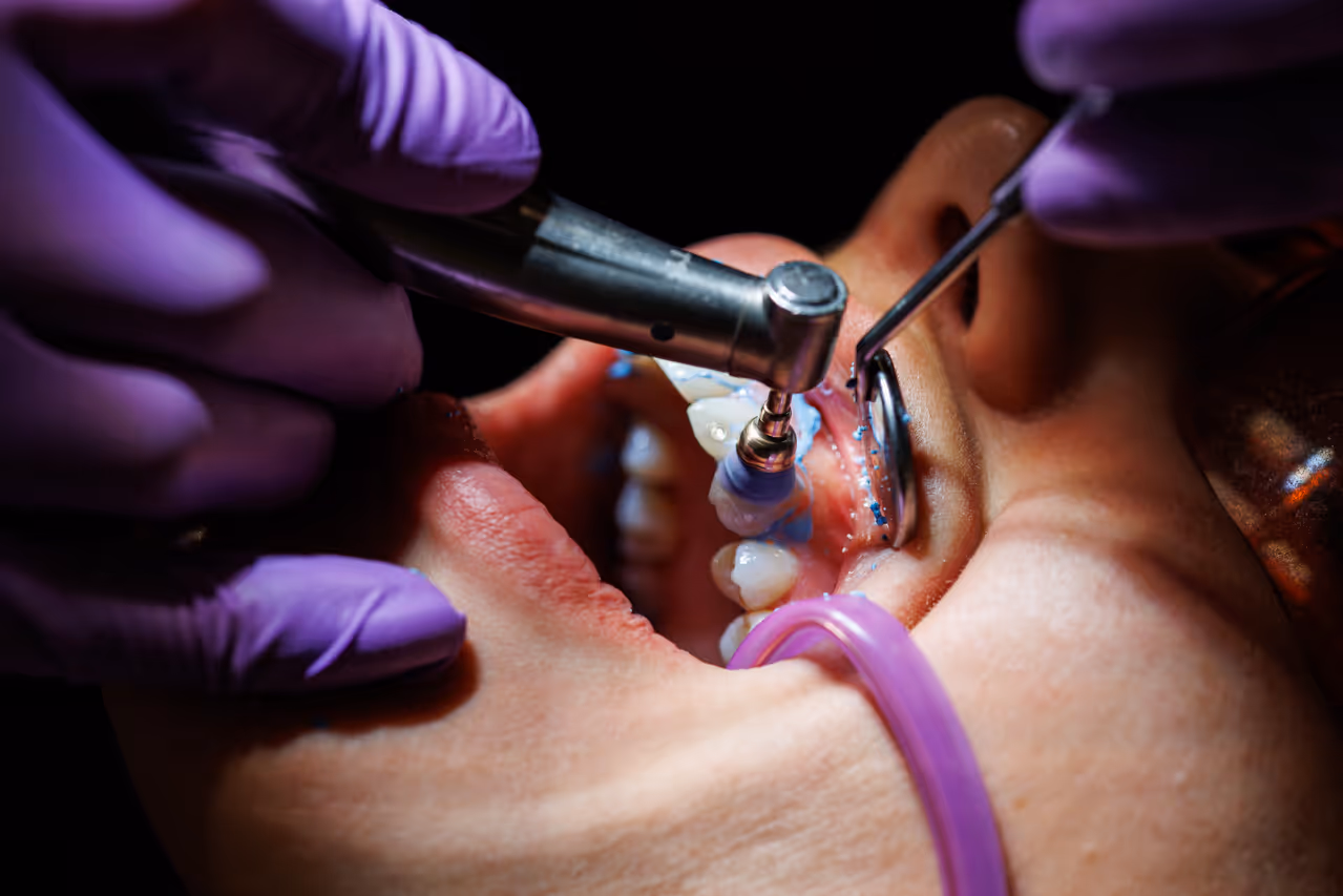 Fluoride Treatment