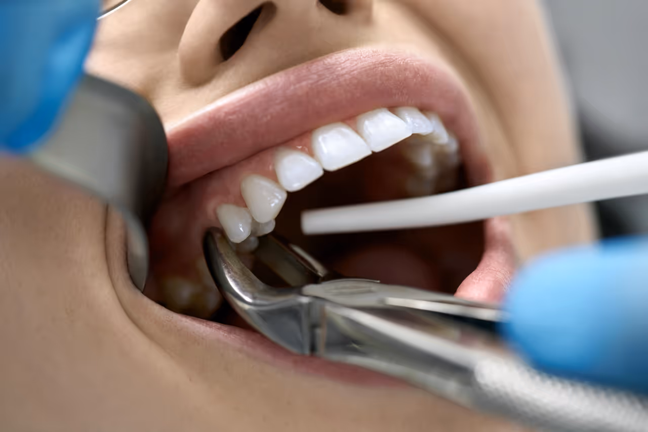 Wisdom Teeth Removal